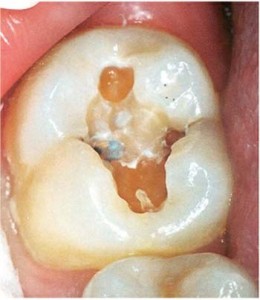 Imagem de Cárie Dentaria