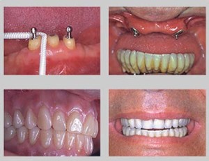 Imagem de Implante Dentário