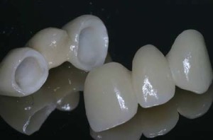 Imagem de ponte dentária