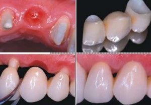 Imagem de prótese dentária fixa