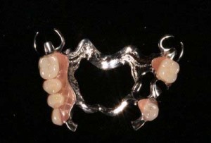 Imagem de prótese dentária removível