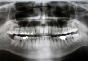 Imagem de Radiografia panorâmica